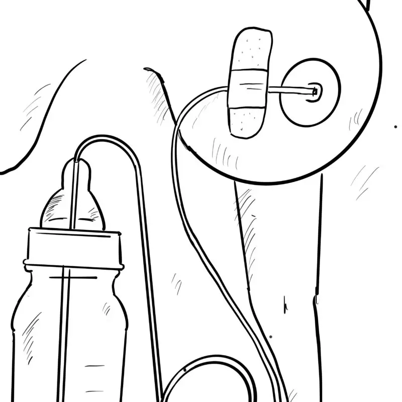 A drawing of an infant bottle and a feeding tube.
